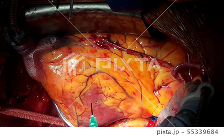 coronary artery bypass grafting on open heart coronary artery bypass grafting on open heart 55339684