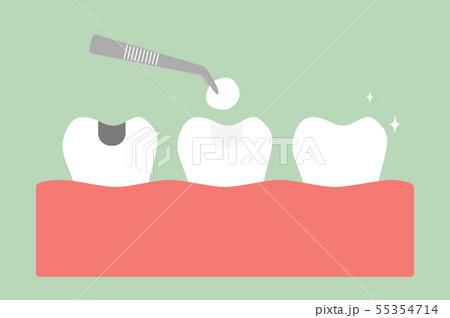 tooth amalgam filling with dental tools tooth amalgam filling with dental tools 55354714