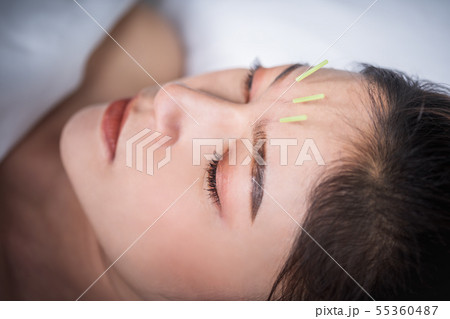 woman undergoing acupuncture treatment on head woman undergoing acupuncture treatment on head 55360487
