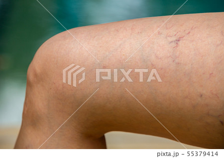 Varicose veins on the thigh and legs in woman 55379414