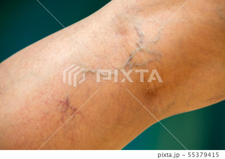 Varicose veins on the back of knee, leg in woman 55379415