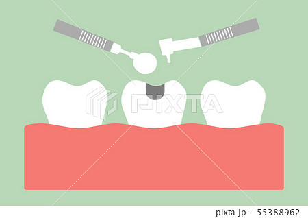 tooth amalgam filling with dental tools tooth amalgam filling with dental tools 55388962