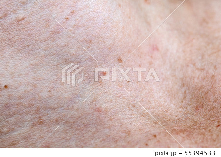 Skin pigmentation. Moles and freckles Skin pigmentation. Moles and freckles 55394533