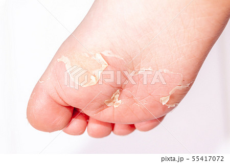 After the red rash and the strawberry tongue caused by scarlet fever the affected skin often peels - After the red rash and the strawberry tongue caused by scarlet fever the affected skin often peels - 55417072