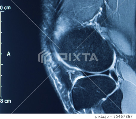 Knee injury mri mcl tear Knee injury mri mcl tear 55467867
