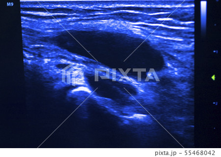 EPI dry needling ultrasound scan 55468042