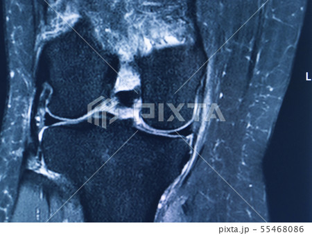 Knee injury mri mcl tear Knee injury mri mcl tear 55468086
