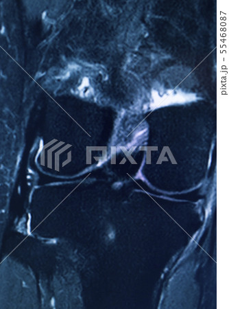 Knee injury mri mcl tear Knee injury mri mcl tear 55468087