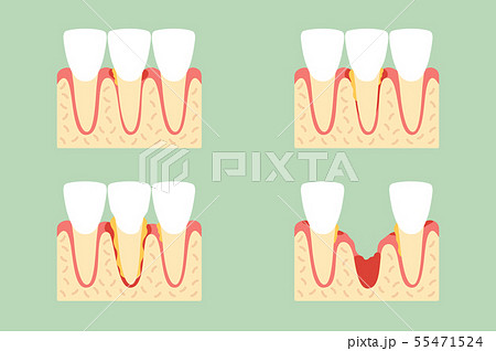 periodontal disease or gingivitis of incisor tooth 55471524