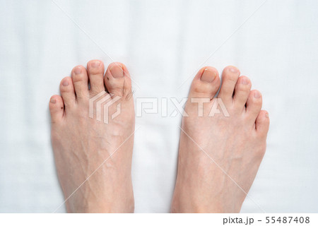 メンズ 足指脱毛 before & afterイメージ 片足のみ メンズ 足指脱毛 before & afterイメージ 片足のみ 55487408