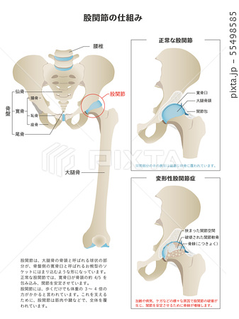 股関節の仕組み 正常な股関節と変形性股関節症 のイラスト素材