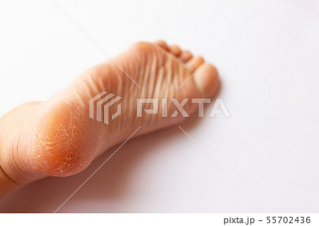 かかとのひび割れと角質	 55702436