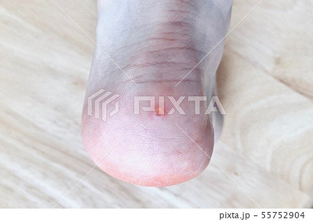 皮膚炎 肌トラブル 肌荒れ 湿疹 虫刺され 症例 11 55752904