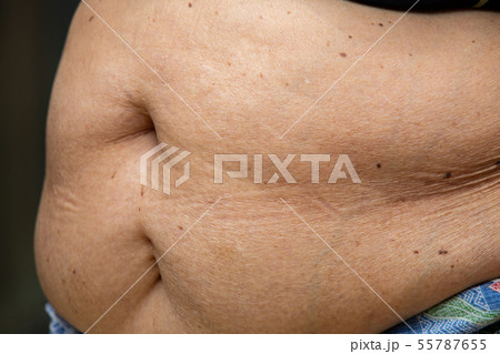 Senior women body fat belly side view, Black mole 55787655
