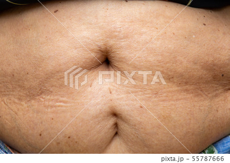 Senior women body fat belly front view, Black mole 55787666