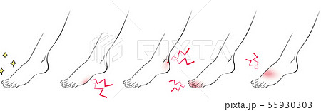 靴擦れの足とキレイな足 靴擦れの足とキレイな足 55930303