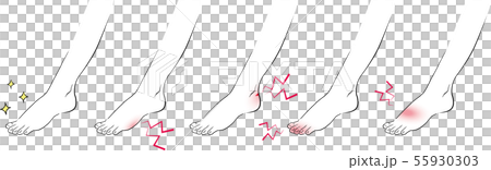 靴擦れの足とキレイな足 靴擦れの足とキレイな足 55930303