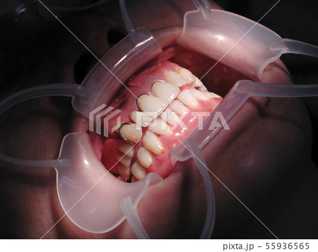 歯科治療 歯科治療 55936565