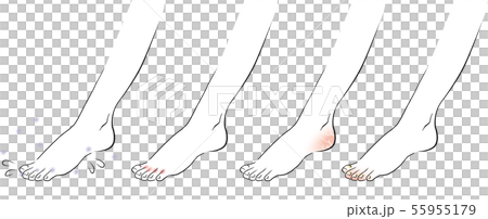 Female feet athlete's foot 55955179