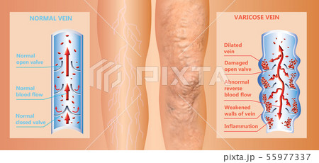 Varicose veins on a female senior legs. The structure of normal and varicose veins. Varicose veins on a female senior legs. The structure of normal and varicose veins. 55977337