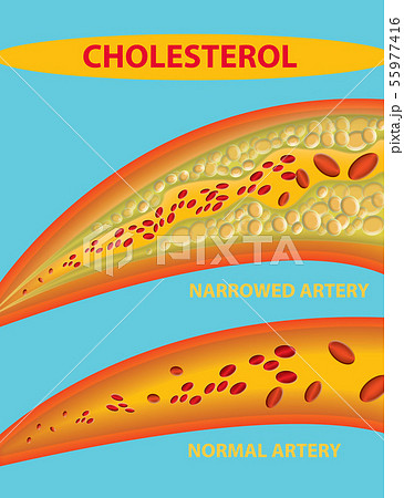 Blocked blood vessel - artery with cholesterol 55977416