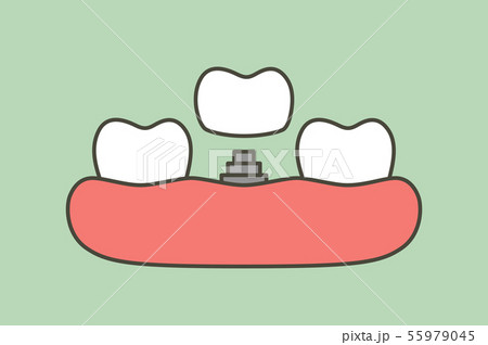 tooth implant, install process and change new root 55979045