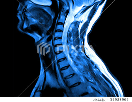 Magnetic resonance imaging of the cervical spine. 55983965