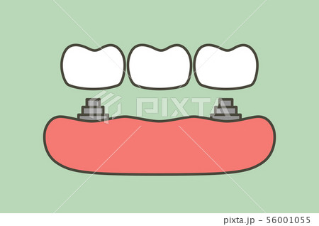 tooth implant with bridge 56001055