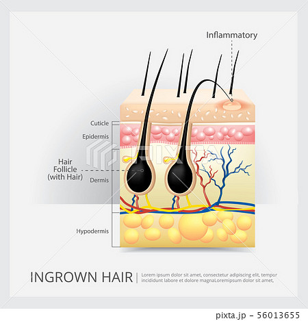 Ingrown Hair Structure Vector Illustration 56013655