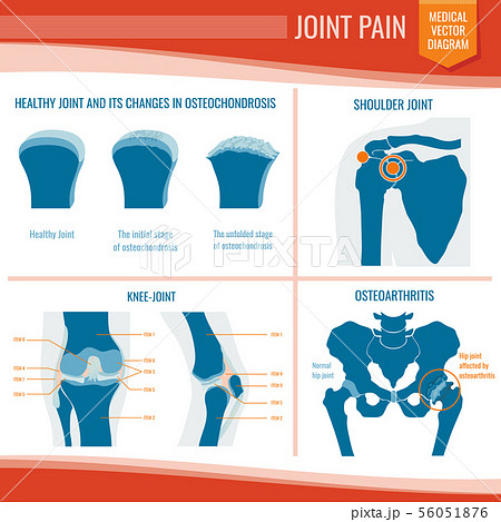 Osteoarthritis and rheumatism joint pain medical vector infographic 56051876