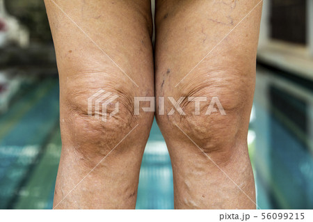 Varicose veins on knees and legs in Senior woman 56099215