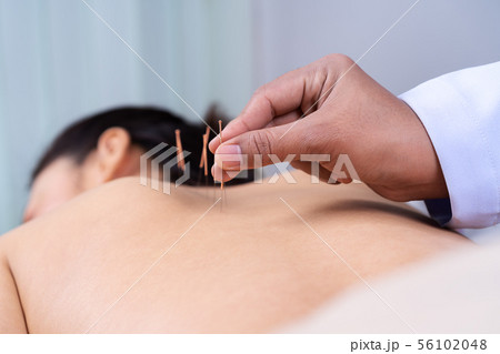 woman undergoing acupuncture treatment on back 56102048