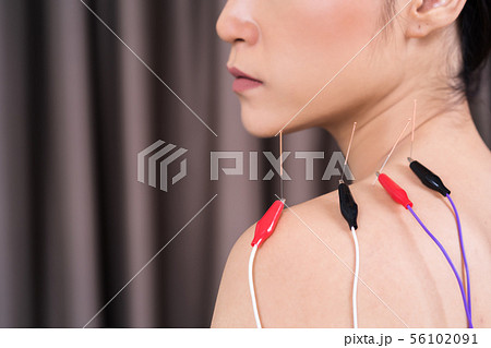woman undergoing acupuncture treatment with 56102091