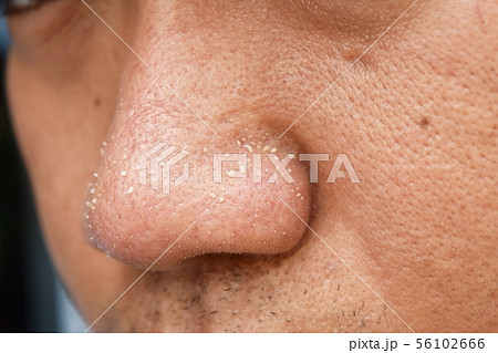 acne vulgaris on nose of asian man 56102666