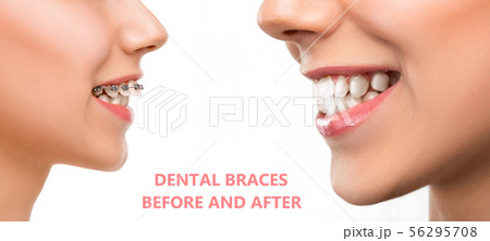 Close up female portrait, dental braces before and after 56295708