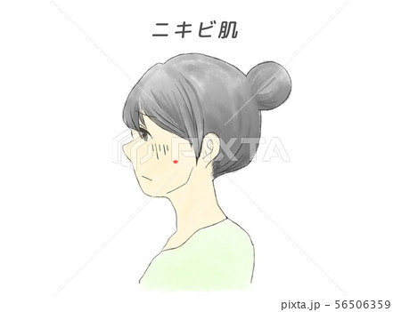 ニキビ肌の女性 ニキビ肌の女性 56506359