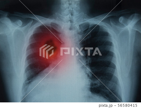 lung cancer 56580415