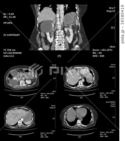 ct scan abdomen and body 56580419
