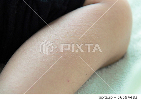 幼児の発疹 幼児の発疹 56594483