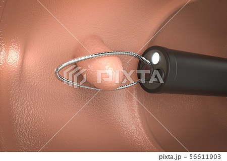 endoscope remove colonic polyp 56611903