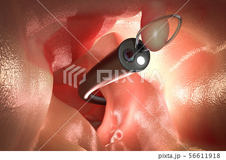 endoscope remove colonic polyp 56611918
