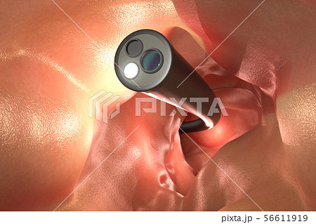 Colonoscopy technology concept 56611919
