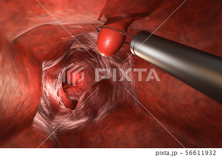 endoscope remove colonic polyp endoscope remove colonic polyp 56611932