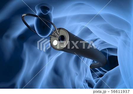 endoscope remove colonic polyp 56611937