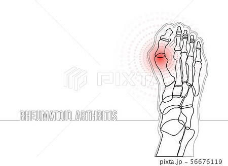 Rheumatoid arthritis continuous line drawing concept banner 56676119