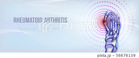 Rheumatoid arthritis bones concept Rheumatoid arthritis bones concept 56676139