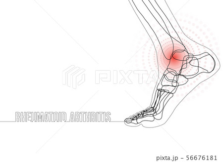Continuous line drawing concept banner about Rheumatoid arthritis 56676181
