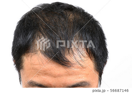 薄毛 56687146