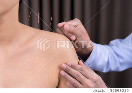 woman undergoing acupuncture treatment on shoulder woman undergoing acupuncture treatment on shoulder 56698019