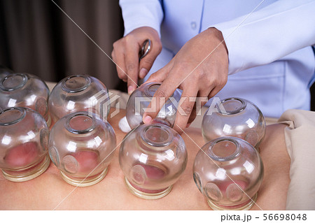 woman receiving cupping treatment on back 56698048